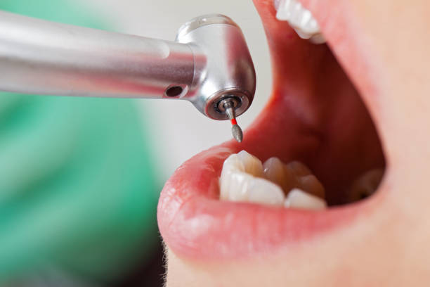 Best Emergency Dental Extractions in Untain Grove, MO